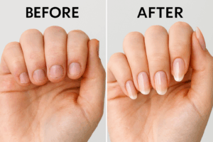 深爪・Before After写真